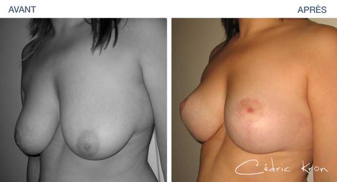 Resultat of a breast lift - ptosis correction in before-and-after photograph