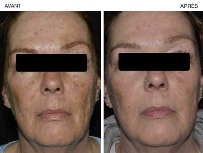Avant-Après : Correction des tâches du visage avec LaseMD Ultra