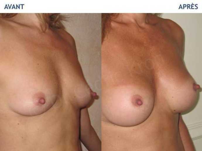 Before - After breast augmentation using implants