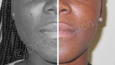 Before & After: Jaw reduction using Botox injections