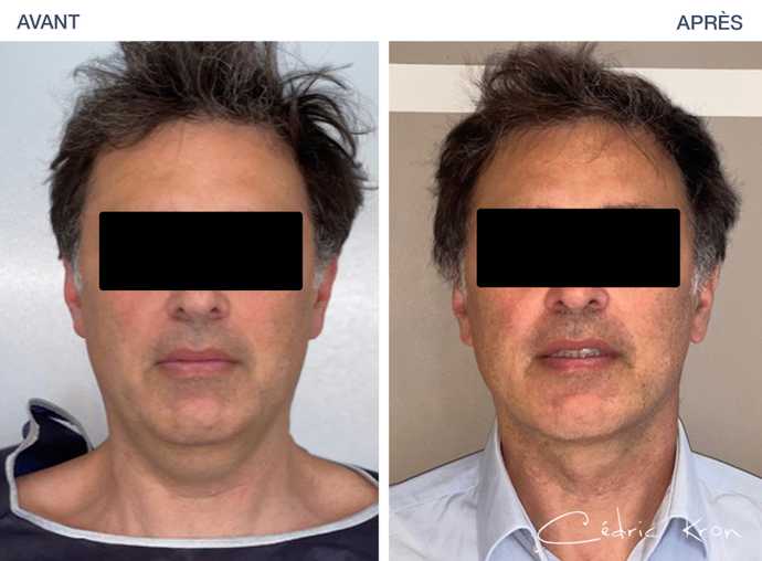 Avant - Après d'une suppression du double menton par lipoaspiration sous mentonnière