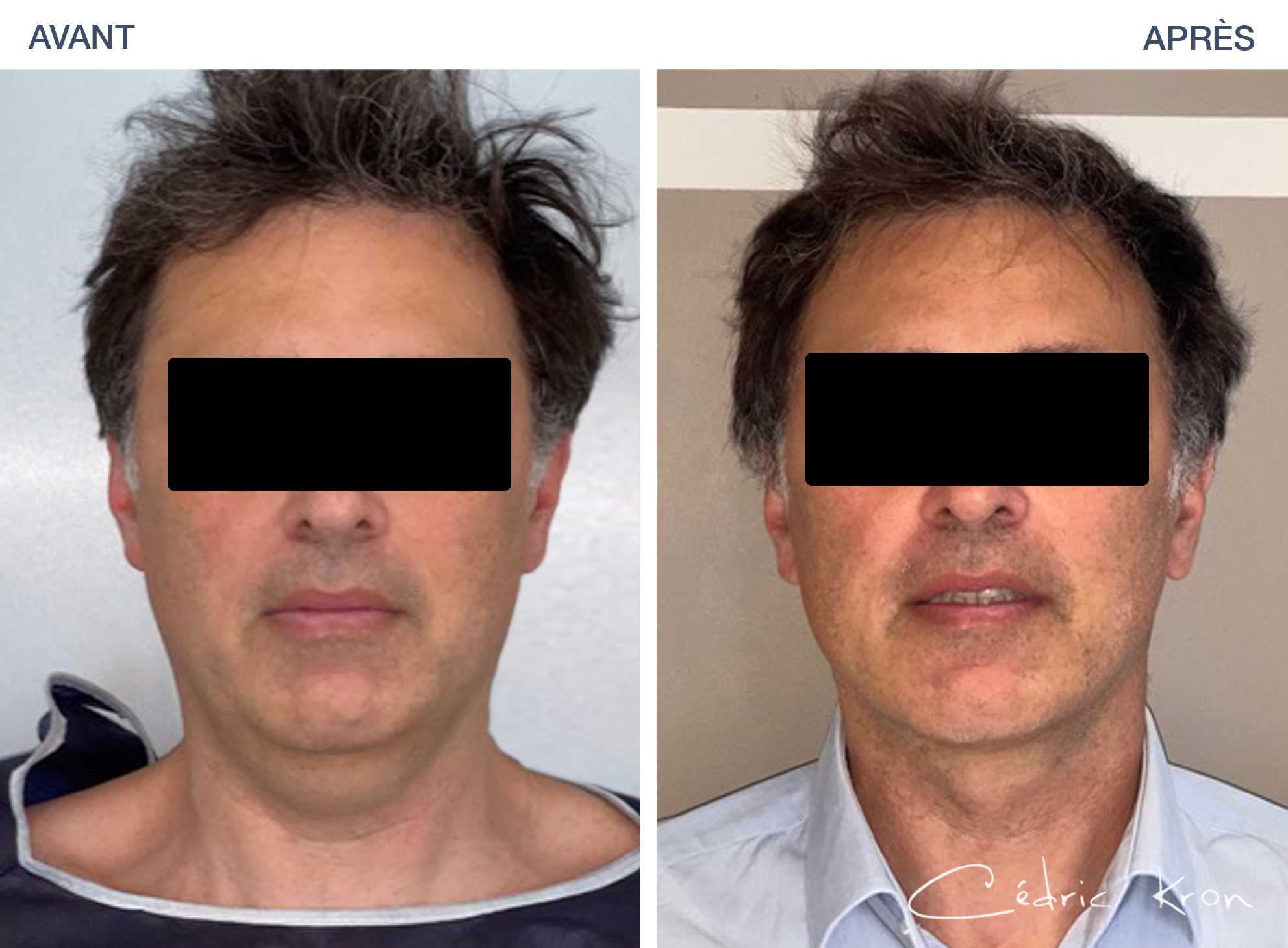 Photos avantaprès Lipoaspiration et Liposuccion Dr Cédric Kron