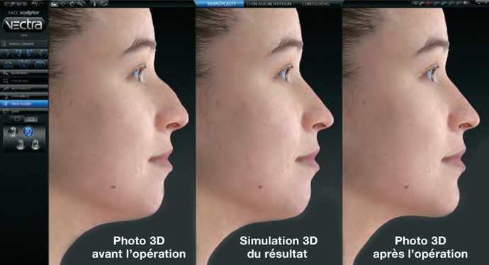 Simulation du résultat d'une rhinoplastie secondaire avec Vectra XT