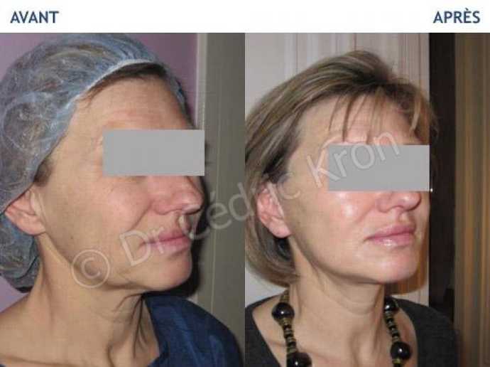 Avant - Après d'un lifting du visage LVPA