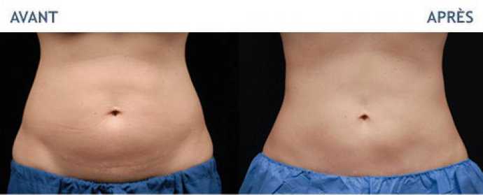 Before & After pictures of Cryolipolyse with Coolsculpting treatment