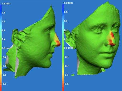 Simulation of the result of a rhinoplasty using 3D photogtaphy