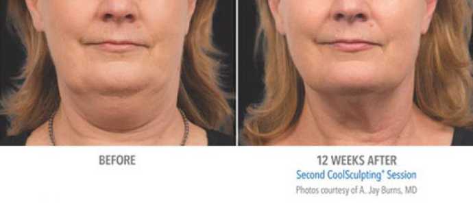 Before - After: neck fat removal using Coolsculpting cryolipolysis technique