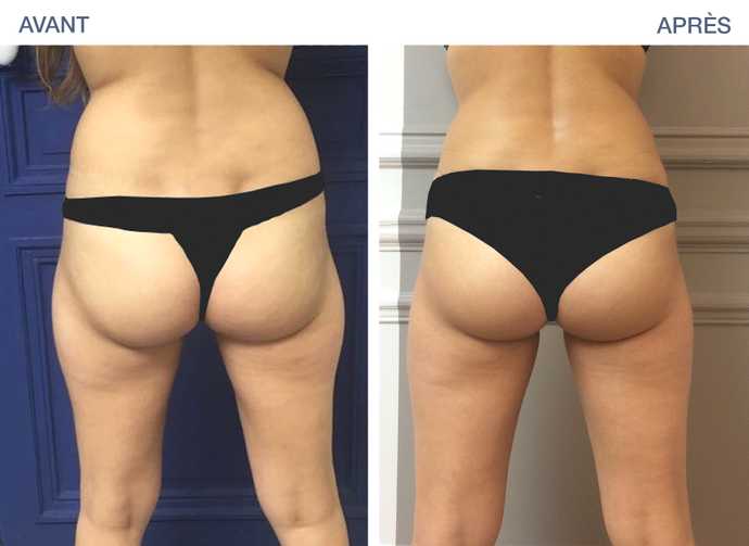 Avant - Après d'un amincissement de la culotte de cheval par cryolipolyse avec coolsculpting