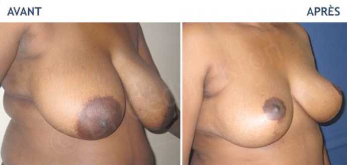 Before - After an aesthetic breast reduction surgery