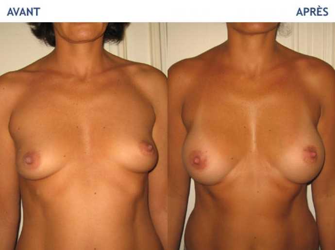 Before - After breast surgery