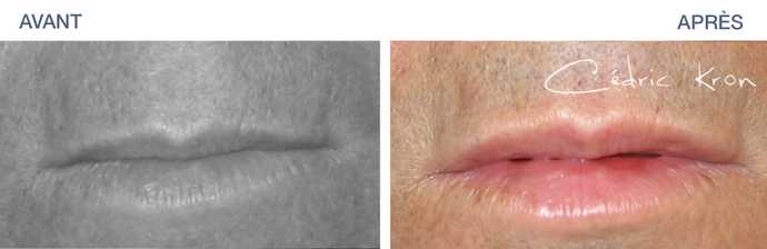 Before - After: lip augmentation on a man