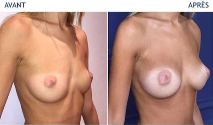 Before and after photo of the result of breast implants