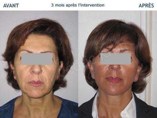 Before & after pictures of a facelif LVPA