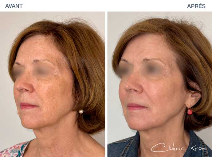 Avant - Après : Traitement des tâches pigmentaires du visage d'une femme d'une cinquantaine d'année ans avec le mode Ultraclear 