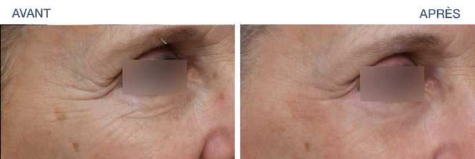 avant apres ultraclear 05