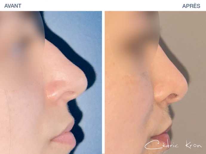 Zomm sur le résultat avant-après d'une rhinoplastie