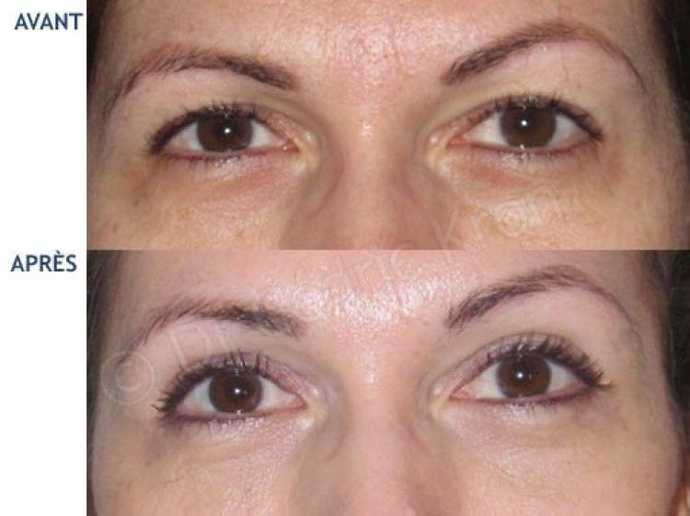 Before & after photos of blepharoplasty