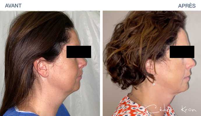 Avant-après : Lipoaspiration de l'ovale visage vue du profil