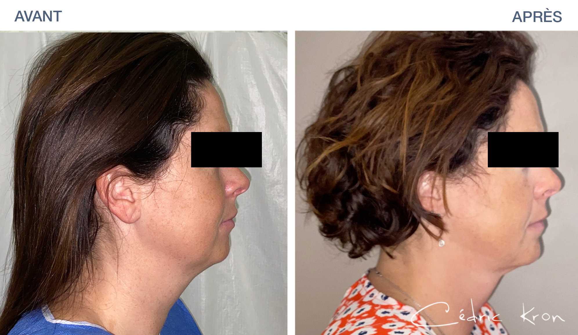 Photos avantaprès Lipoaspiration et Liposuccion Dr Cédric Kron
