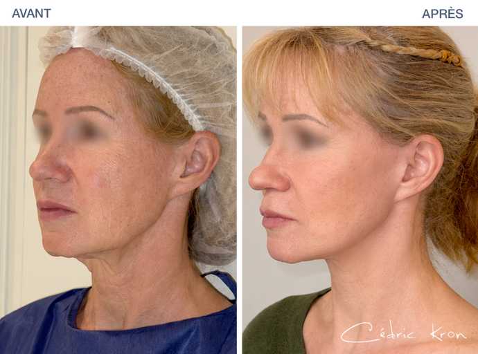 Avant - Après :Lifting LVPA du cou, de l'ovale du visage et des pommettes sur une femme de 59 ans 