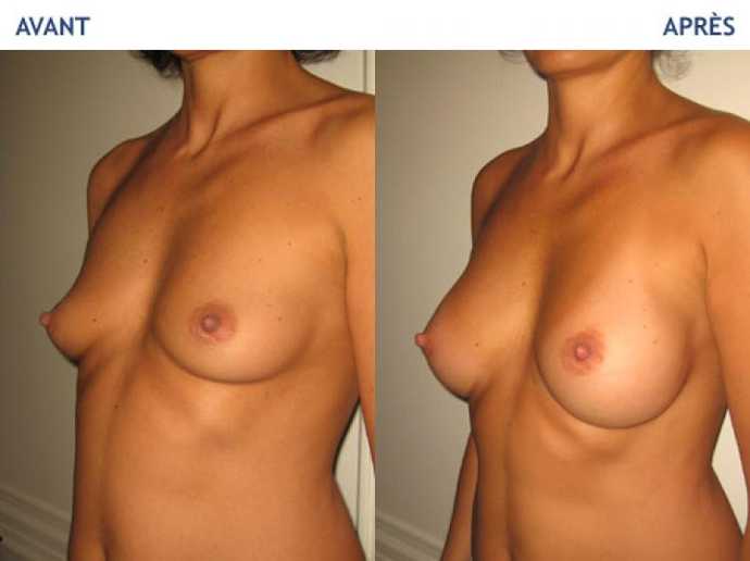 Before - After breast surgery