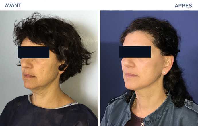 Résultat d'un lifting du visage du type LVPA en photo avant-après