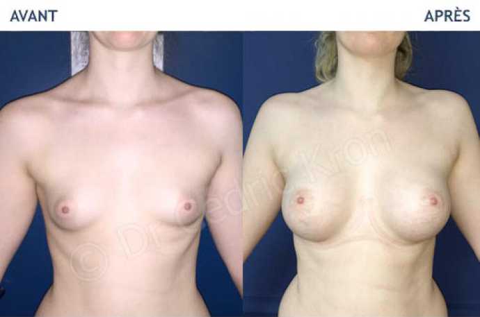 Before - After breast augmentation using implants