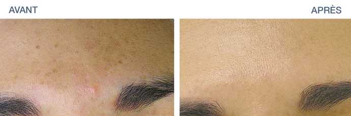 Before - After: HydraFacial Treatment of Pigment Spots