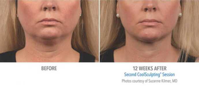 Before - After: removing double chin effect with Coolsculpting cryolipolysis technique