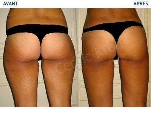 Liposuction: before - after