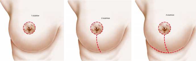 Different positions of the scar involved in a breast lift surgery