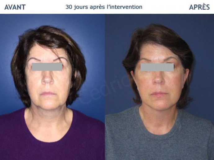 Avant - Après Lifting cervico-facial