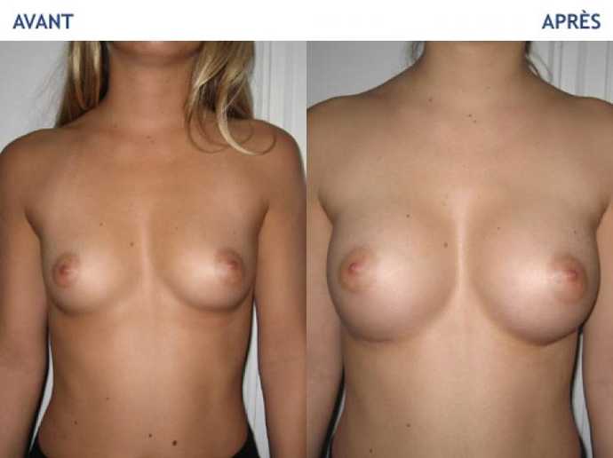 Before - After breast augmentation using implants