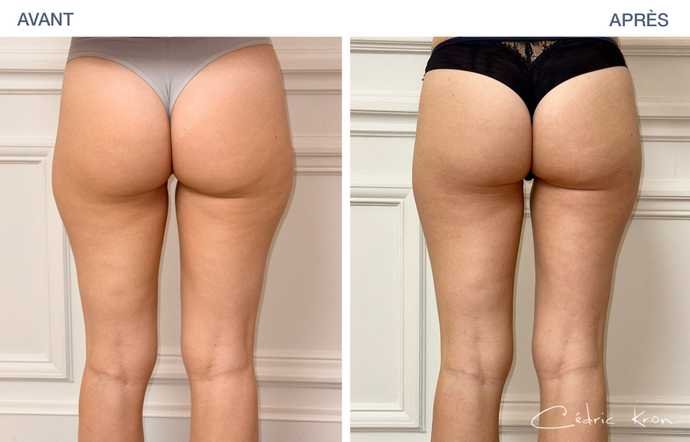 Avant - Après : Traitement de la culotte de cheval avec la Cryolipolyse Coolsculpting