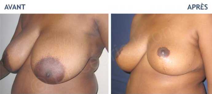 Avant - Après d'une chirurgie esthétique de réduction mammaire