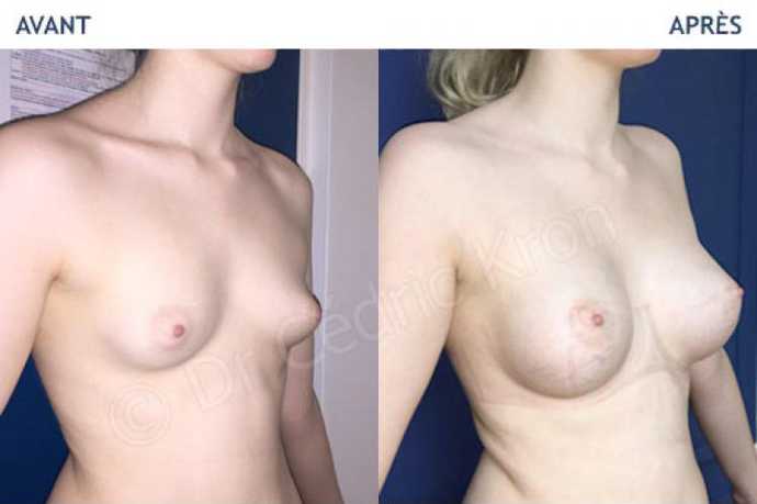 Avant - Après d'une augmentation mammaire par prothèses