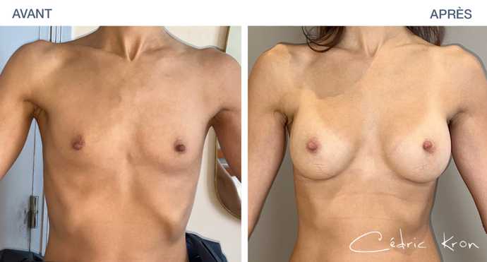 Résultat d'une augmentation mammaire modérée et la plus naturelle possible