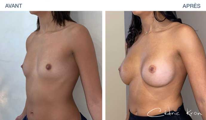Photo avant-après du résultat d'une augmentation mammaire par protheses en silicone ergonomix