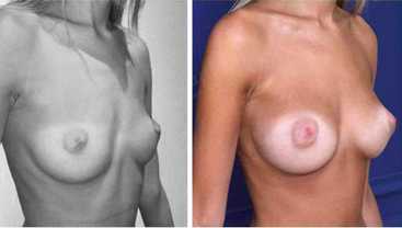 Before & After: Breast implants