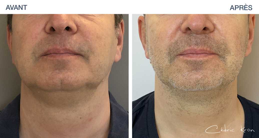 Supprimer les bajoues et les graisses du visage sans chirurgie — free download
