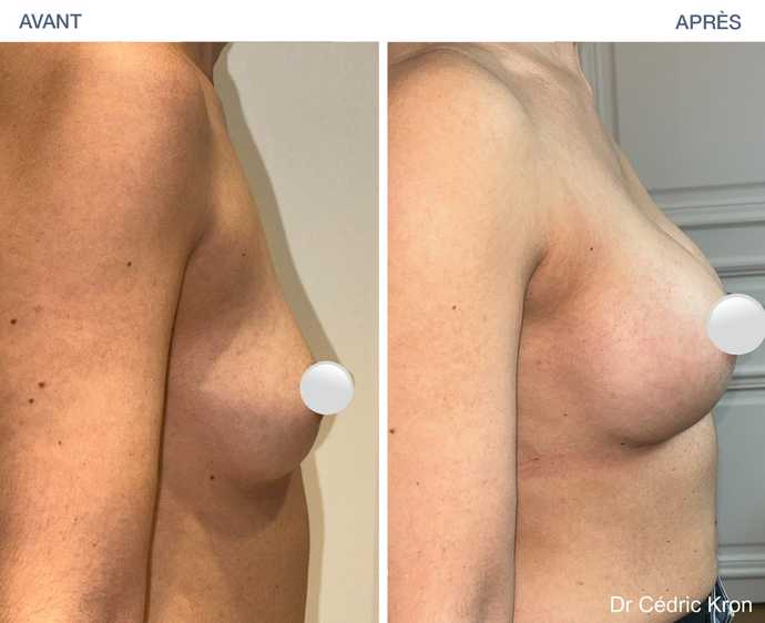 Résultat d'une augmentation mammaire avec des implants Ergonomix 2 chez une femme de 38 ans