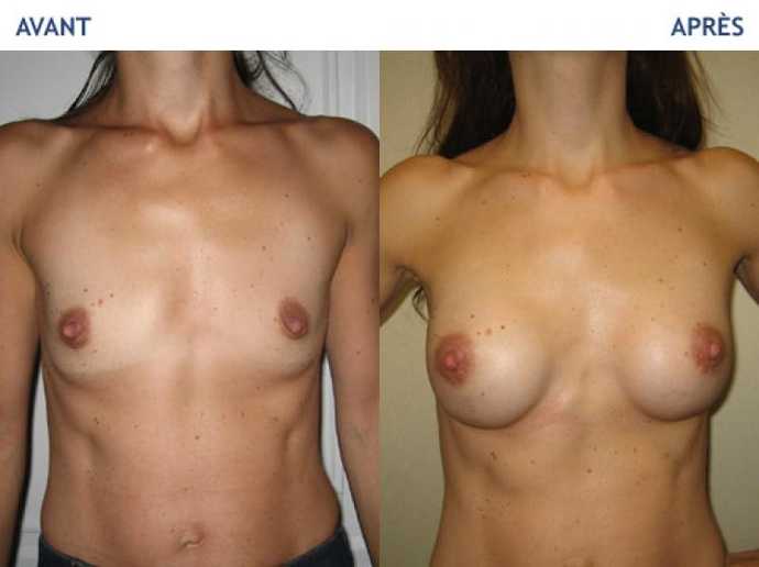 Before - After breast augmentation using implants