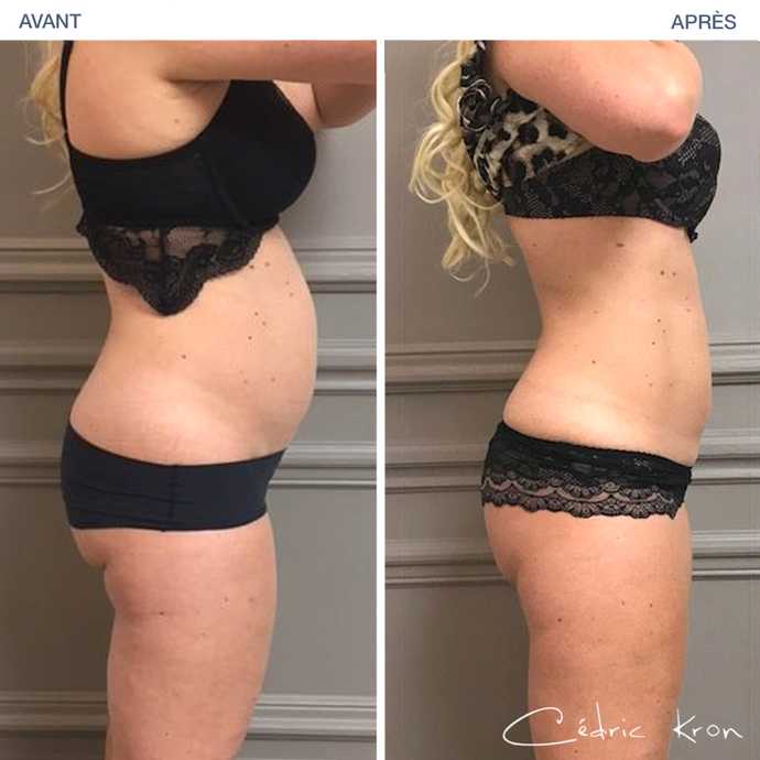 Resultat in before-after picture: Thinning of the belly with CoolSculpting