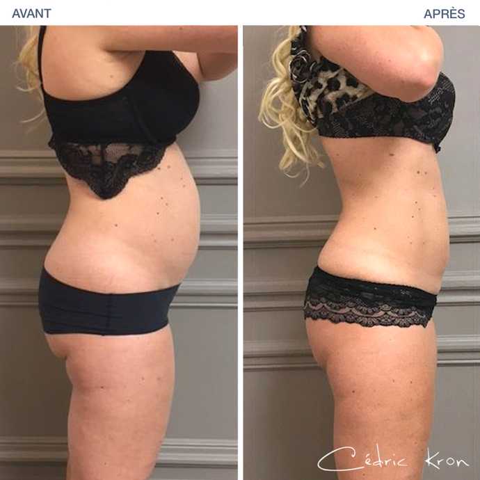 Avant - Après : Supprimer la graisse du ventre avec Coolsculpting