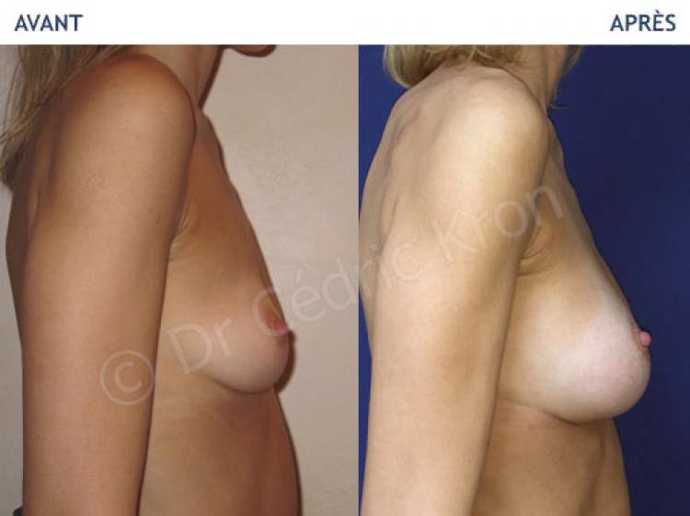 Before - After breast augmentation using implants