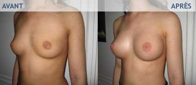 Before and after pictures of plastic surgery procedures