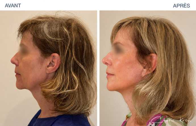 Before - After pictures : facelift LVPA on a 58-year-old woman
