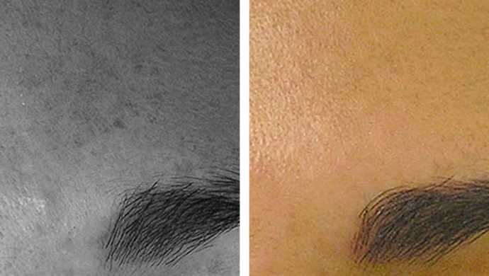 Before - After: Result of a HydraFacial treatment