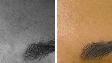 Before & After: HydraFacial treatments