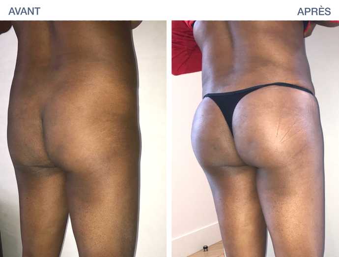 Result obtained after a buttock lipofilling
